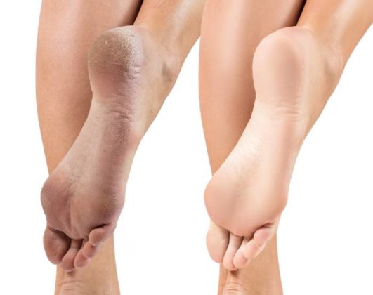 Homemade-Cracked-Heel-Remedy-531x420